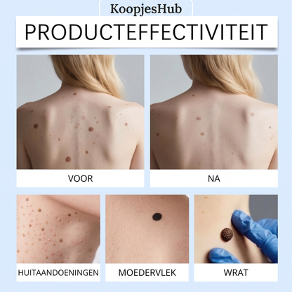 ClearRoller™ Roller Serum - Geavanceerd Een Heldere Huid