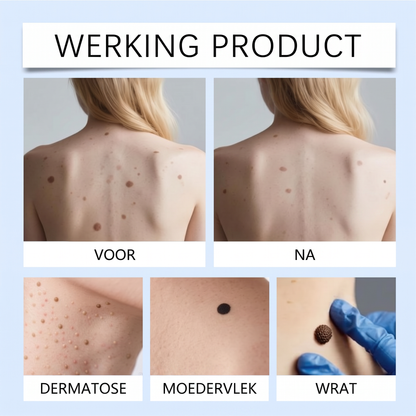 ClearRoller™ Roller Serum - Geavanceerd Een Heldere Huid
