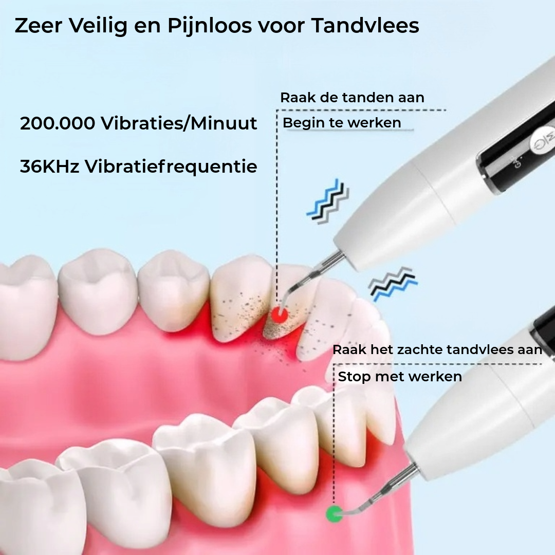 GlowSmile – Ultrasone reiniging voor een zichtbaar frissere glimlach