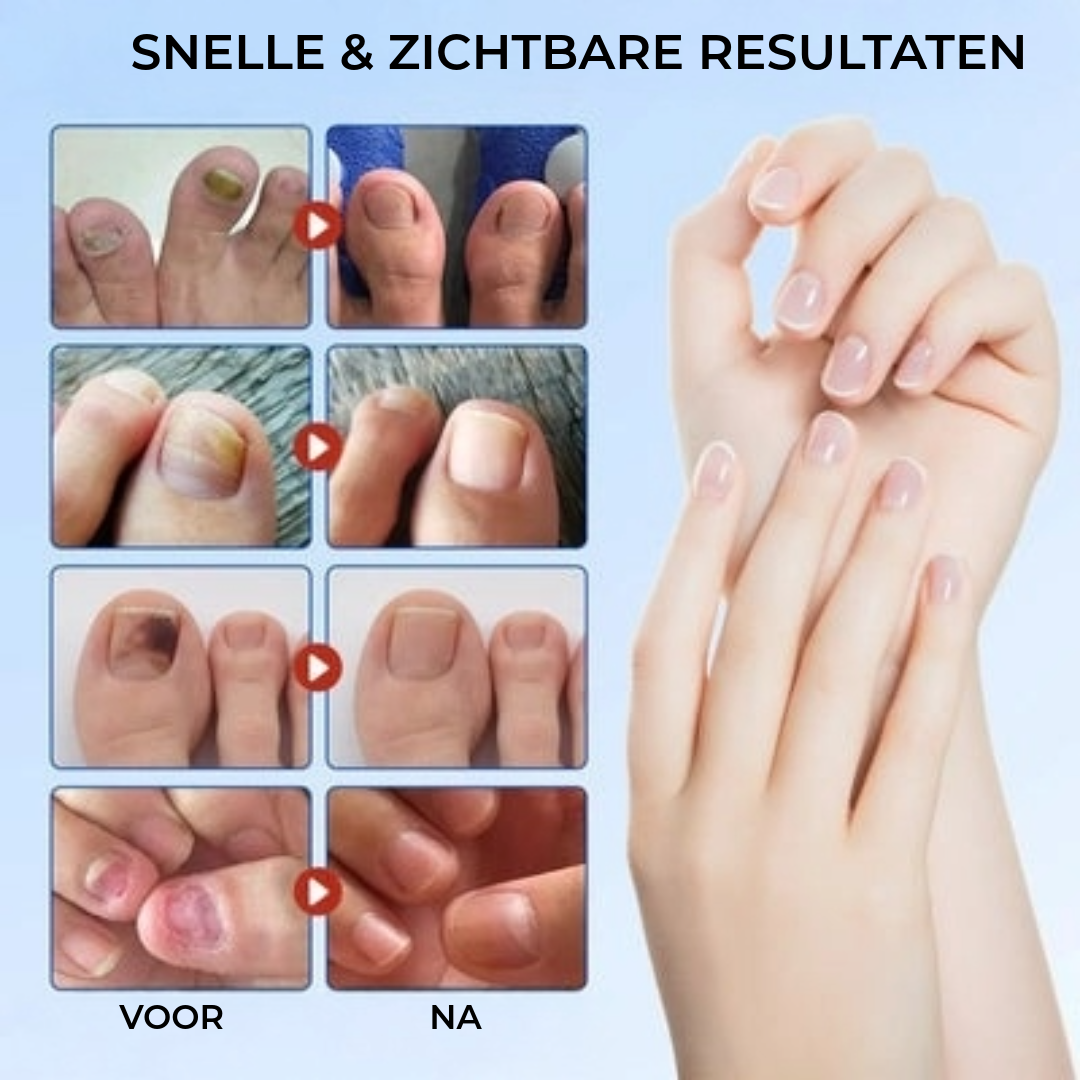 FungalPatch - Antibacterieel Schimmelwerend Patch En Nagelverzorging Pak