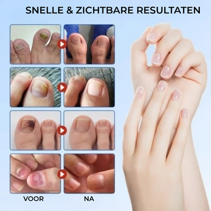 FungalPatch - Antibacterieel Schimmelwerend Patch En Nagelverzorging Pak